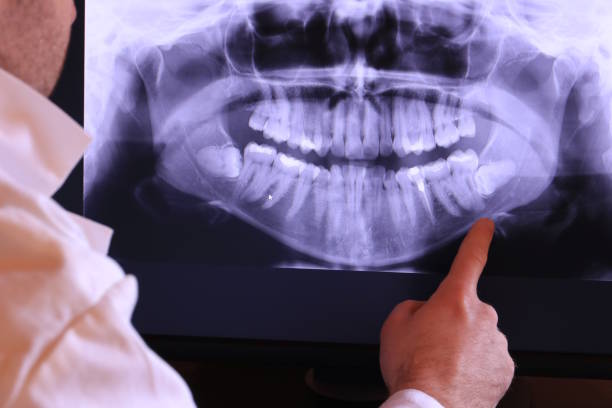 Best Emergency Wisdom Tooth Extraction in Tekamah, NE
